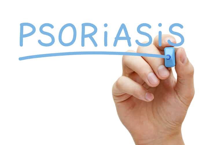 Someone writing the word psoriasis to outline what to do to help heal psoriasis