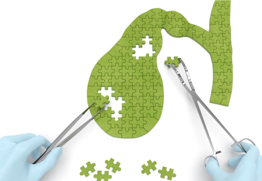 Green puzzle being put back together representing adding fats into diet after gallbladder surgery